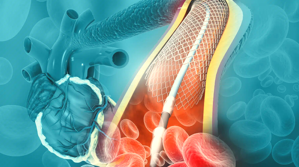 angioplastika.jpg